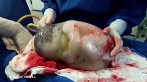 Niesamowite narodziny – dziecko urodziło się w nienaruszonym worku owodniowym [Video]