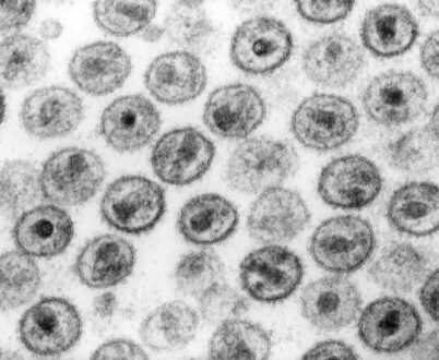 Po raz trzeci na świecie udało się wyleczyć chorego na raka nosiciela wirusa HIV
